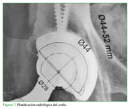 Planificación radiológica del cotilo.