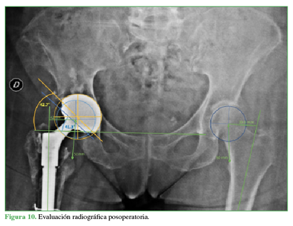 Evaluación radiográfica posoperatoria.