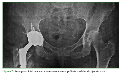 Reemplazo total de cadera no cementada con prótesis modular de fijación distal. 