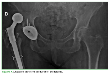 Luxación protésica irreductible. D:derecha. 