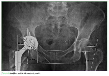 Análisis radiográfico preoperatorio.