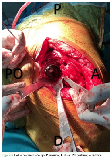 Cotilo no cementado fijo. P proximal, D distal, PO posterior, A anterior. 