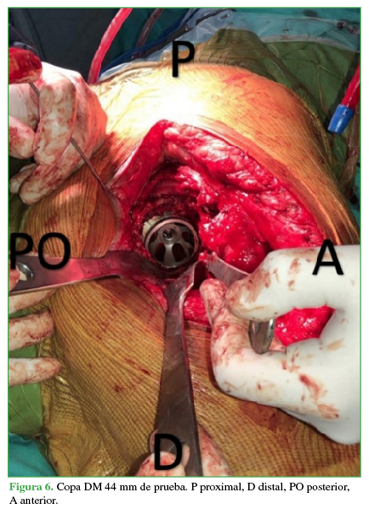 Copa DM 44 mm de prueba. P proximal, D distal, PO posterior, A anterior.