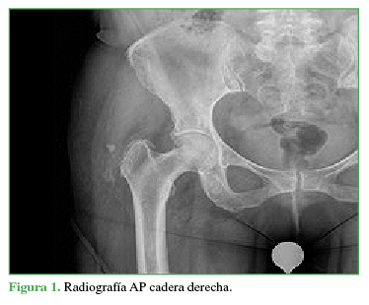 Radiografía AP cadera derecha.