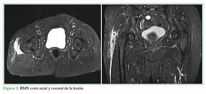 RMN corte axial y coronal de la lesión.