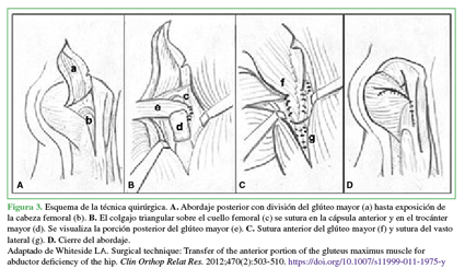 Esquema de la técnica quirúrgica. A. Abordaje posterior con división del glúteo mayor (a) hasta exposición de la cabeza femoral (b). B. El colgajo triangular sobre el cuello femoral (c) se sutura en la cápsula anterior y en el trocánter mayor (d). Se visualiza la porción posterior del glúteo mayor (e). C. Sutura anterior del glúteo mayor (f)  y sutura del vasto lateral (g). D. Cierre del abordaje. Adaptado de Whiteside LA. Surgical technique: Transfer of the anterior portion of the gluteus maximus muscle for abductor deficiency of the hip. Clin Orthop Relat Res. 2012;470(2):503-510. https://doi.org/10.1007/s11999-011-1975-y