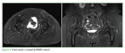 Corte axial y coronal de RMN control.