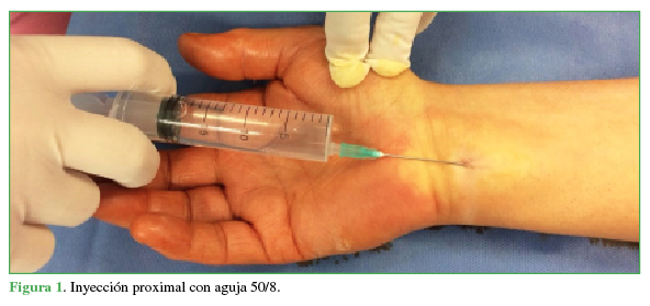 Inyección proximal con aguja 50/8.