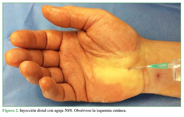 Inyección distal con aguja 50/8. Obsérvese la isquemia cutánea.
