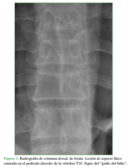 Radiografía de columna dorsal, de frente. Lesión de aspecto lítico centrada en el pedículo derecho de la vértebra T10. Signo del "guiño del búho".