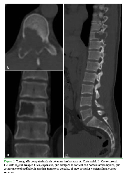 Tomografía computarizada de columna lumbosacra. A. Corte axial. B. Corte coronal. C. Corte sagital. Imagen lítica, expansiva, que adelgaza la cortical con bordes interrumpidos, que compromete el pedículo, la apófisis transversa derecha, el arco posterior y extensión al cuerpo vertebral. 