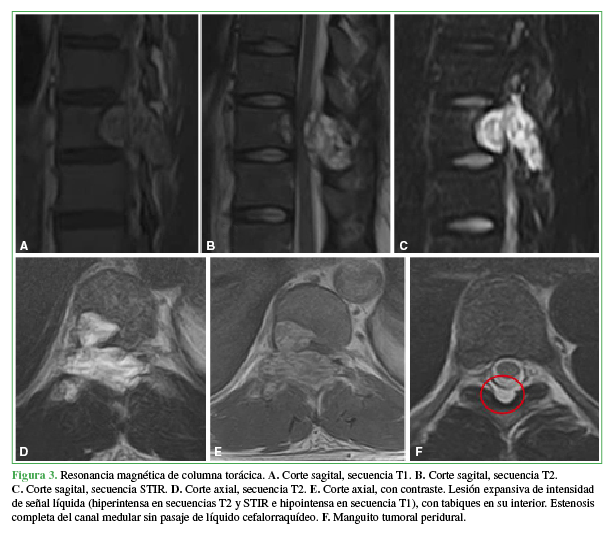 Resonancia magnética de columna torácica. A. Corte sagital, secuencia T1. B. Corte sagital, secuencia T2. C. Corte sagital, secuencia STIR. D. Corte axial, secuencia T2. E. Corte axial, con contraste. Lesión expansiva de intensidad de señal líquida (hiperintensa en secuencias T2 y STIR e hipointensa en secuencia T1), con tabiques en su interior. Estenosis completa del canal medular sin pasaje de líquido cefalorraquídeo. F. Manguito tumoral peridural. 