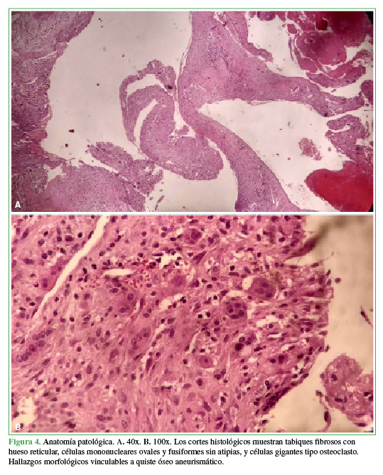 Anatomía patológica. A. 40x. B. 100x. Los cortes histológicos muestran tabiques fibrosos con hueso reticular, células mononucleares ovales y fusiformes  sin atipias, y células gigantes tipo osteoclasto. Hallazgos morfológicos vinculables a quiste óseo aneurismático. 