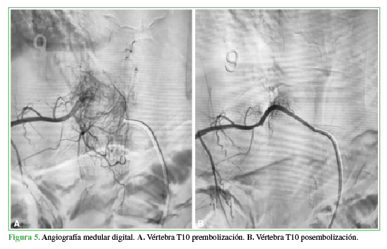 Angiografía medular digital. A. Vértebra T10 prembolización. B. Vértebra T10 posembolización. 