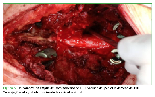 Descompresión amplia del arco posterior de T10. Vaciado del pedículo derecho de T10. Curetaje, fresado y alcoholización de la cavidad residual. 