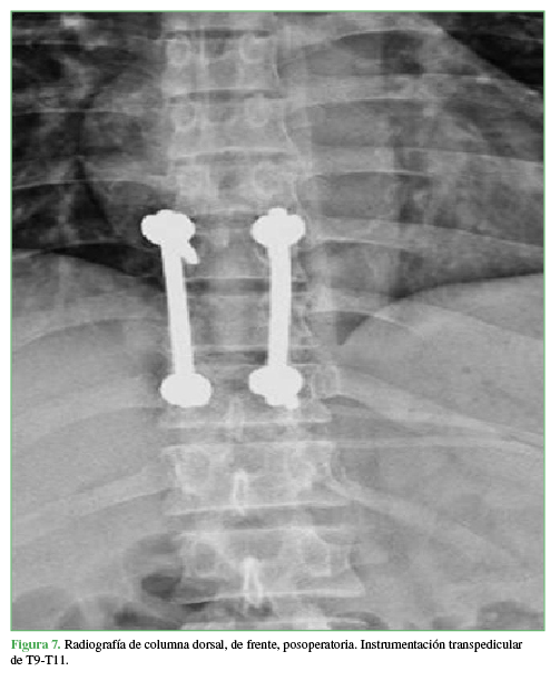 Radiografía de columna dorsal, de frente, posoperatoria. Instrumentación transpedicular de T9-T11. 