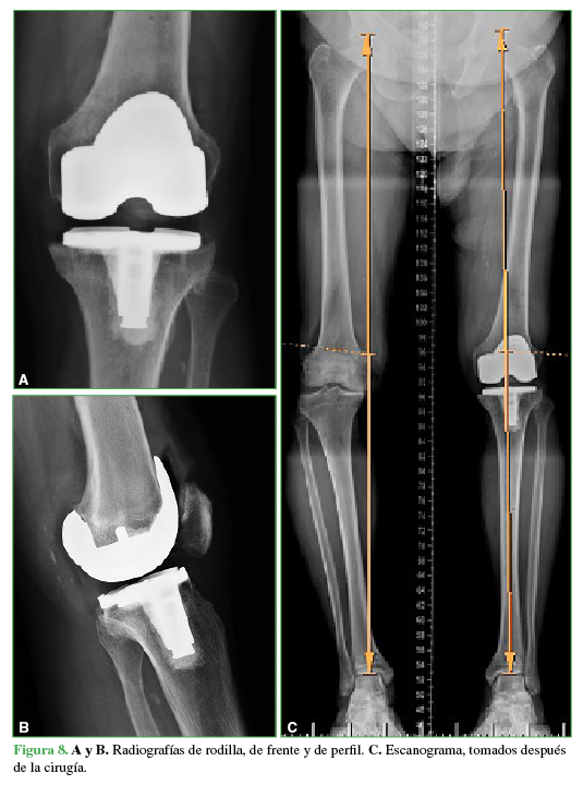 A y B. Radiografías de rodilla, de frente y de perfil. C. Escanograma, tomados después de la cirugía. 