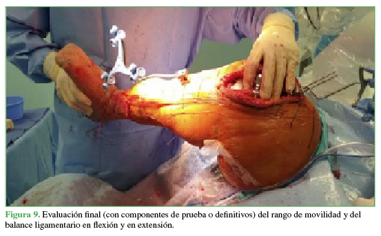 Evaluación final (con componentes de prueba o definitivos) del rango de movilidad y del balance ligamentario en flexión y en extensión.