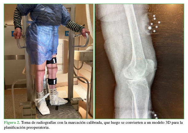 Toma de radiografías con la marcación calibrada, que luego se convierten a un modelo 3D para la planificación preoperatoria. 