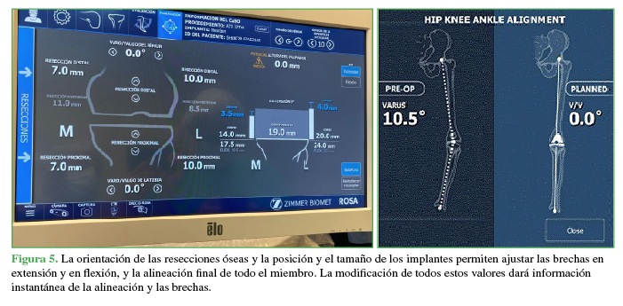 La orientación de las resecciones óseas y la posición y el tamaño de los implantes permiten ajustar las brechas en extensión y en flexión, y la alineación final de todo el miembro. La modificación de todos estos valores dará información instantánea de la alineación y las brechas. 