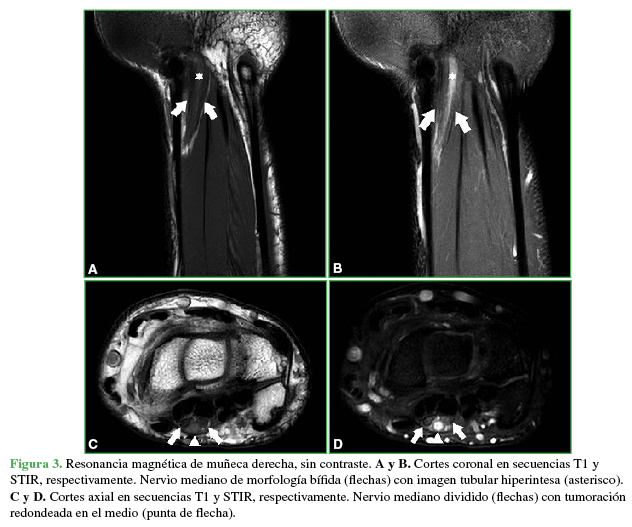 Resonancia magnética de muñeca derecha , sin contraste. A y B. Cortes coronal en secuencias T1 y STIR, respectivamente. Nervio mediano de morfología bífida (flechas) con imagen tubular hiperintensa (asterisco). C y D. Cortes axial en secuencias T1 y STIR, respectivamente. Nervio mediano dividido (flechas) con tumoración redondeada en el medio (punta de flecha). 