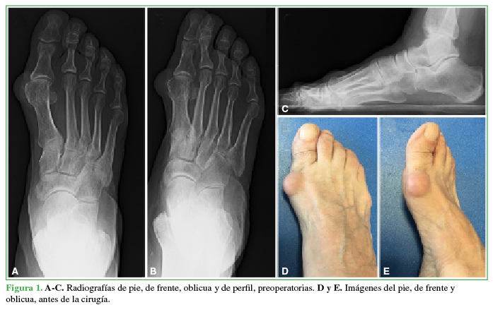 A-C. Radiografías de pie, de frente, oblicua y de perfil, preoperatorias. D y E. Imágenes del pie, de frente y
oblicua, antes de la cirugía.