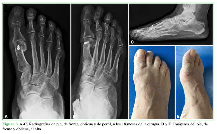 A-C. Radiografías de pie, de frente, oblicua y de perfil, a los 18 meses de
la cirugía. D y E. Imágenes del pie,
de frente y oblicua, al alta.