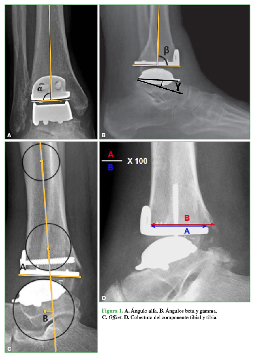 Figura 1.A. Ángulo
alfa. B. Ángulos beta y gamma. C.Offset.
D. Cobertura del componente tibial y
tibia.
