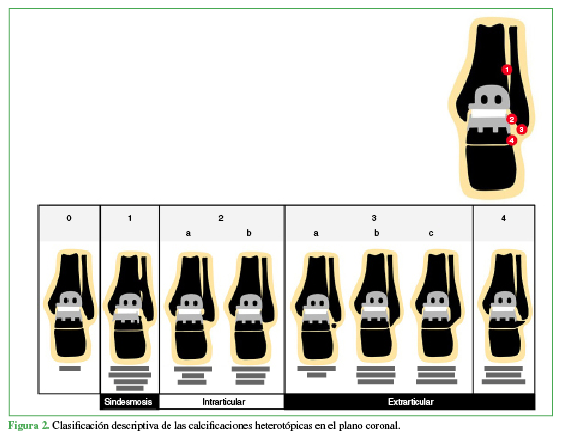 Figura 2.
Clasificación descriptiva de las calcificaciones heterotópicas en el plano
coronal.