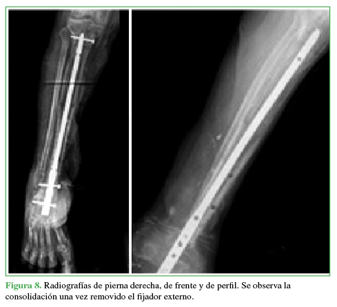 Figura 8.
Radiografías de pierna derecha, de frente y de perfil. Se observa la consolidación una vez removido el fijador externo.