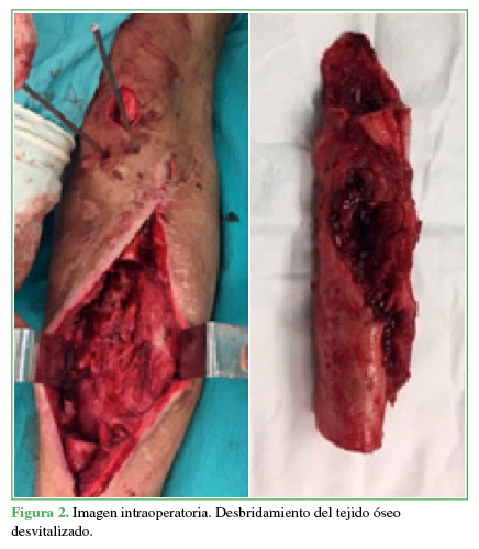 Imagen
intraoperatoria. Desbridamiento del tejido óseo desvitalizado.