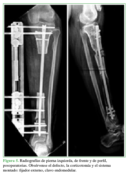 Radiografías de pierna izquierda, de frente y de perfil, posoperatorias. Obsérvense el defecto, la corticotomía
y el sistema montado: fijador externo, clavo endomedular.