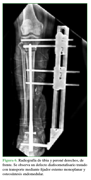 Radiografía
de tibia y peroné derechos, de frente. Se observa un defecto diafisometafisario tratado con transporte mediante fijador
externo monoplanar y osteosíntesis endomedular.