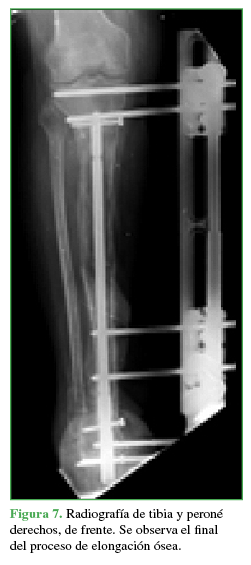 Radiografía
de tibia y peroné derechos, de frente. Se observa el final del proceso de
elongación ósea.