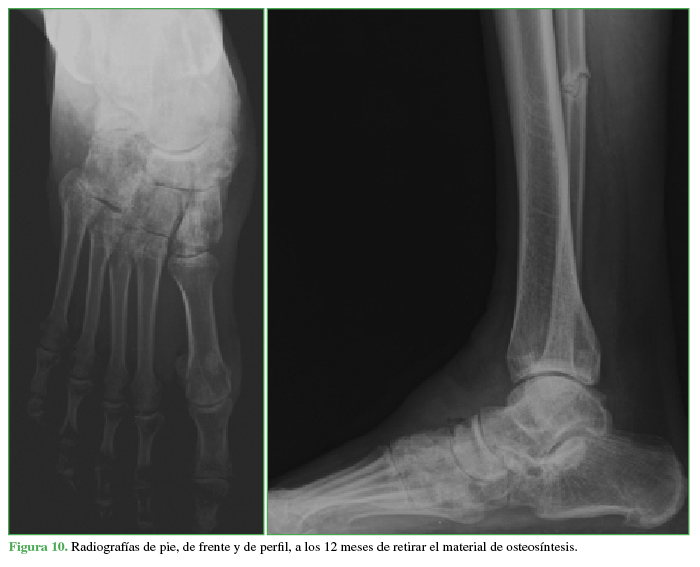 Radiografías de pie, de frente y de perfil, a los 12 meses de retirar el material de osteosíntesis.