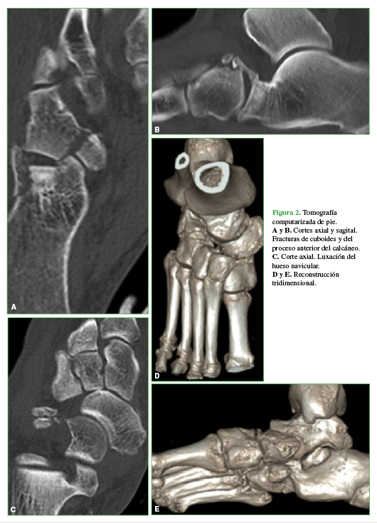 Tomografía computarizada
de pie. A y B. Cortes axial y
sagital. Fracturas de cuboides y del proceso anterior del calcáneo. C. Corte axial. Luxación del hueso
navicular. D y E. Reconstrucción
tridimensional.