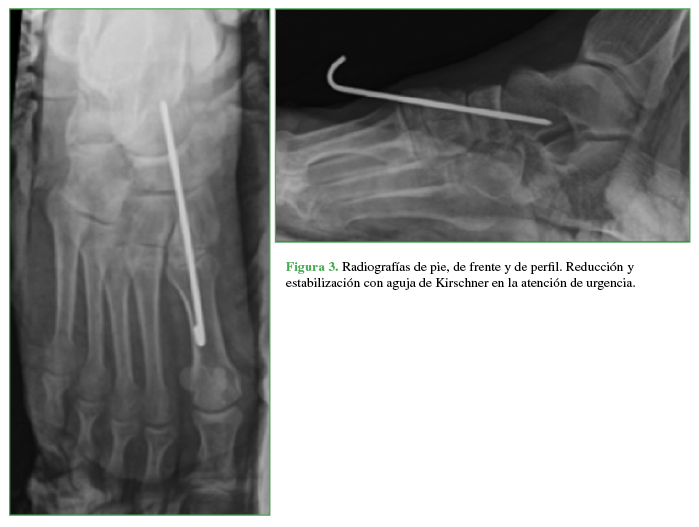 Radiografías de pie, de frente y de perfil. Reducción y estabilización con
aguja de Kirschner en la atención de urgencia.