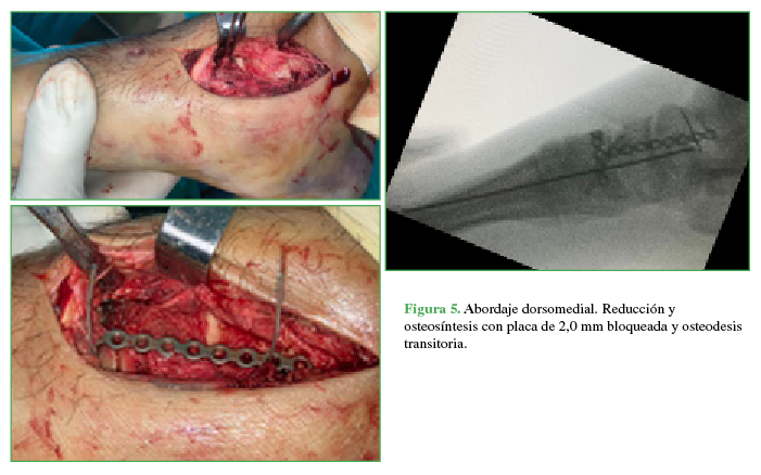 Abordaje dorsomedial. Reducción y osteosíntesis con placa de 2,0 mm
bloqueada y osteodesis transitoria.