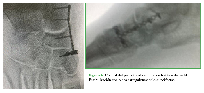 Control del
pie con radioscopia, de frente y de perfil. Estabilización con placa astragalonaviculo-cuneiforme.