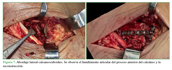 Abordaje
lateral calcaneocuboideo. Se observa el hundimiento
articular del proceso anterior del calcáneo y la reconstrucción.
