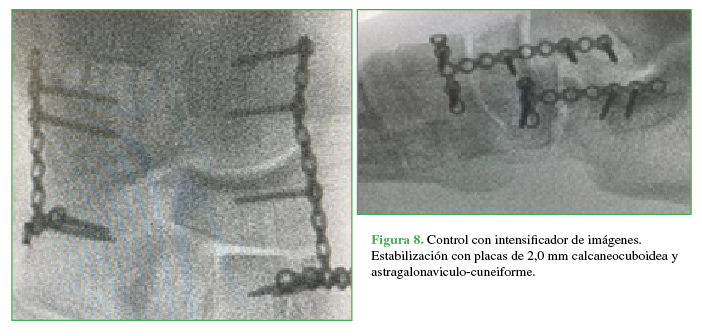 Control con
intensificador de imágenes. Estabilización con placas de 2,0 mm calcaneocuboidea y astragalonaviculo-cuneiforme.