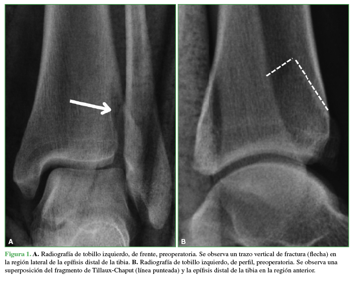 A. Radiografía
de tobillo izquierdo, de frente, preoperatoria. Se observa un trazo vertical de
fractura (flecha) en la región lateral de la epífisis distal de la tibia. B. Radiografía de tobillo izquierdo, de
perfil, preoperatoria. Se observa una superposición del fragmento de Tillaux-Chaput (línea punteada) y la epífisis distal de la
tibia en la región anterior.