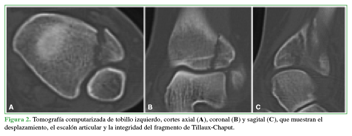 Tomografía
computarizada de tobillo izquierdo, cortes axial (A), coronal (B) y sagital (C), que
muestran el desplazamiento, el escalón articular y la integridad del fragmento
de Tillaux-Chaput.