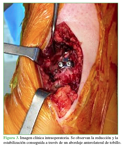 Imagen
clínica intraoperatoria. Se observan la reducción y la estabilización
conseguida a través de un abordaje anterolateral de tobillo.