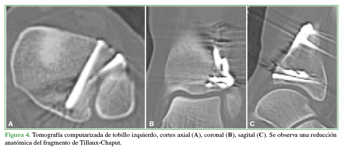 Tomografía
computarizada de tobillo izquierdo, cortes axial (A), coronal (B), sagital (C). Se
observa una reducción anatómica del fragmento de Tillaux-Chaput.