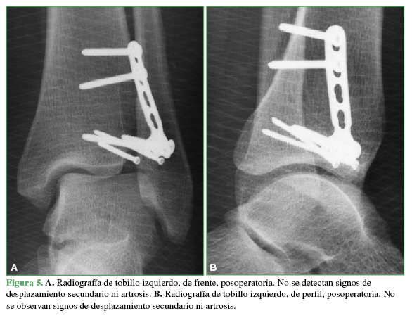 A. Radiografía
de tobillo izquierdo, de frente, posoperatoria. No se detectan signos de
desplazamiento secundario ni artrosis. B.
Radiografía de tobillo izquierdo, de perfil, posoperatoria. No se observan
signos de desplazamiento secundario ni artrosis.