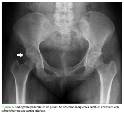 Radiograf&iacute;a panor&aacute;mica de pelvis. Se observan incipientes
cambios artr&oacute;sicos con sobrecobertura acetabular  (flecha).
