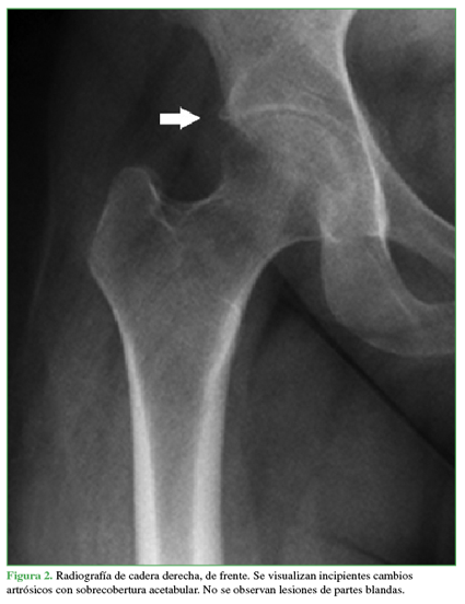 Radiograf&iacute;a de cadera derecha, de
frente. Se visualizan incipientes cambios artr&oacute;sicos con sobrecobertura
acetabular. No se observan lesiones de partes blandas.