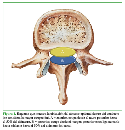 Esquema que muestra la ubicación del
absceso epidural dentro del conducto (se considera la mayor ocupación). A =
anterior, ocupa desde el muro posterior hasta el 50% del diámetro. B =
posterior, ocupa desde el margen posterior osteoligamentario hacia adelante
hasta el 50% del diámetro del canal.