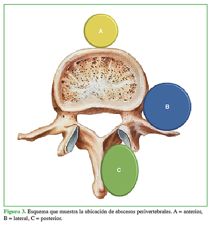 Esquema que muestra la ubicación de
abscesos perivertebrales. A = anterior, B = lateral, C = posterior. 

 